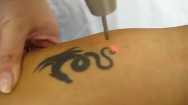 Татуировките - Как да премахнем Тато с лазер !