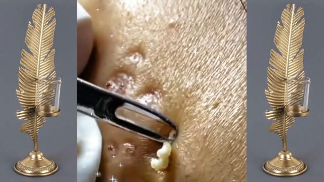 Best Vevo Blackheads removal | Vevo dr Acne Treatment |pimple popping | acne by Vevo.dr acne 009