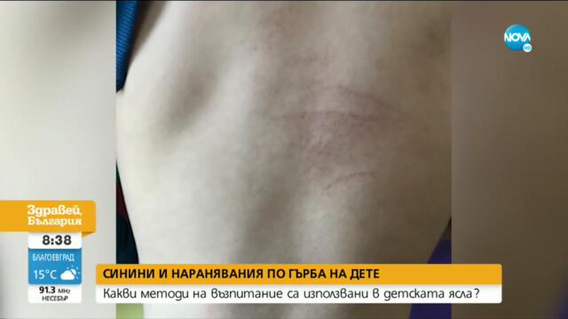 Синини и наранявания по гърба на дете: Какво се е случило в яслата? - Здравей, България (26.05.2021)