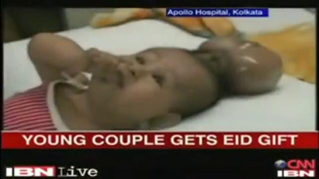 Роди се бебе с два мозъка